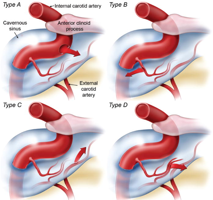 Carotid–Cavernous Fistula - Hình ảnh minh họa